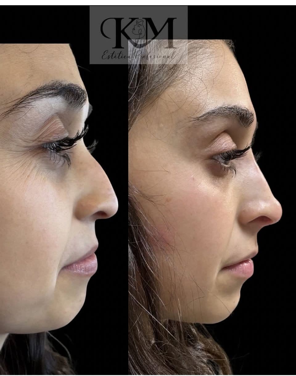 Antes y después — Perfil facial: Armonización y rejuvenecimiento