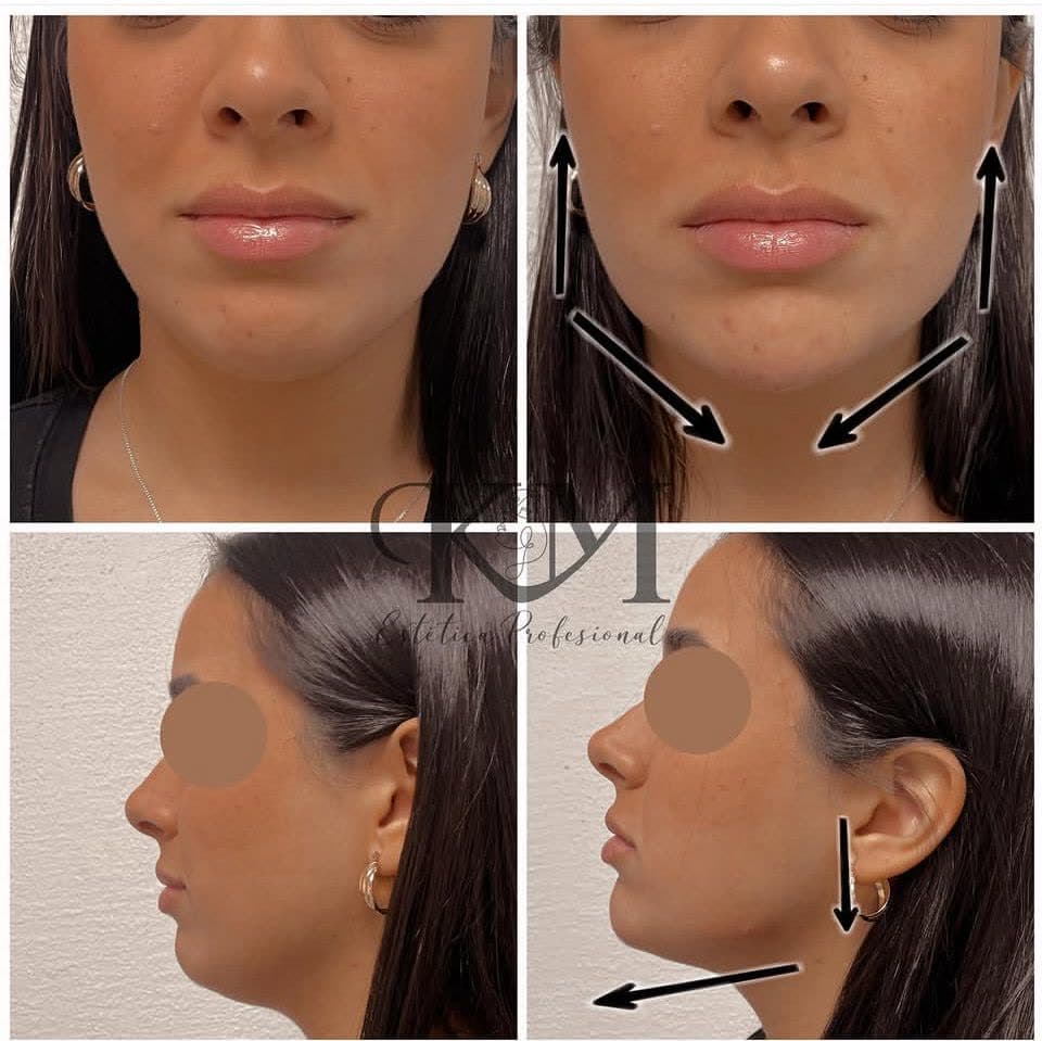Antes y después — Marcación mandibular: Contorno de mandíbula y mentón