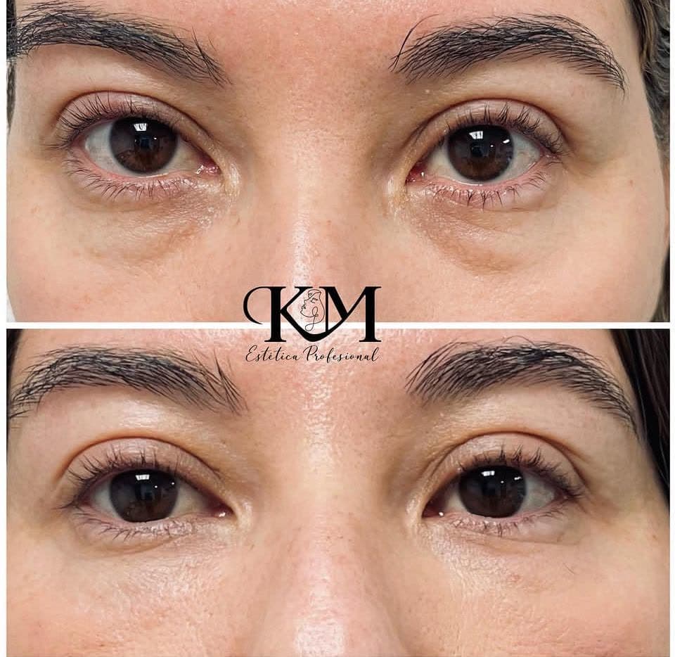 Antes y después — Ojeras: Corrección de ojeras y bolsas