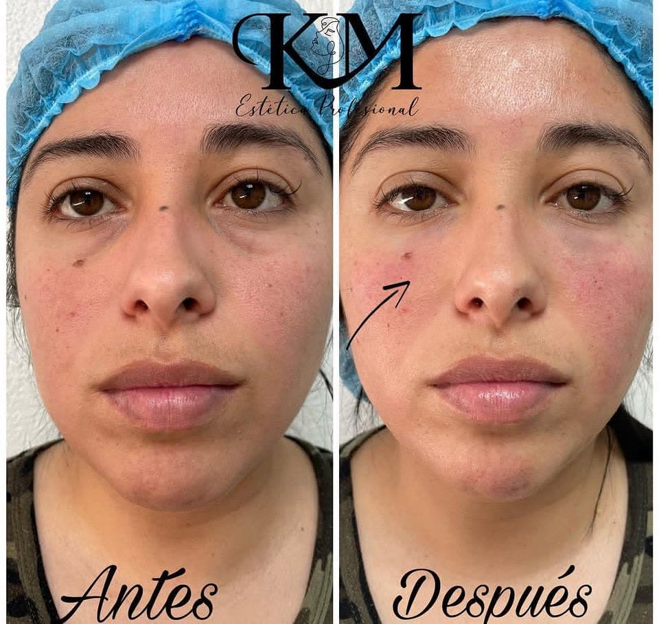 Antes y después — Calidad de piel: Tratamiento facial regenerativo