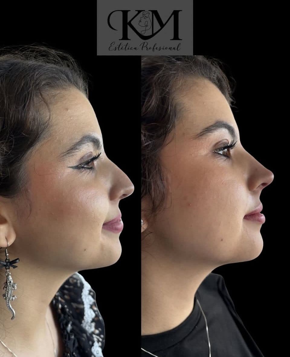 Antes y después — Rinomodelación: Perfil nasal sin cirugía