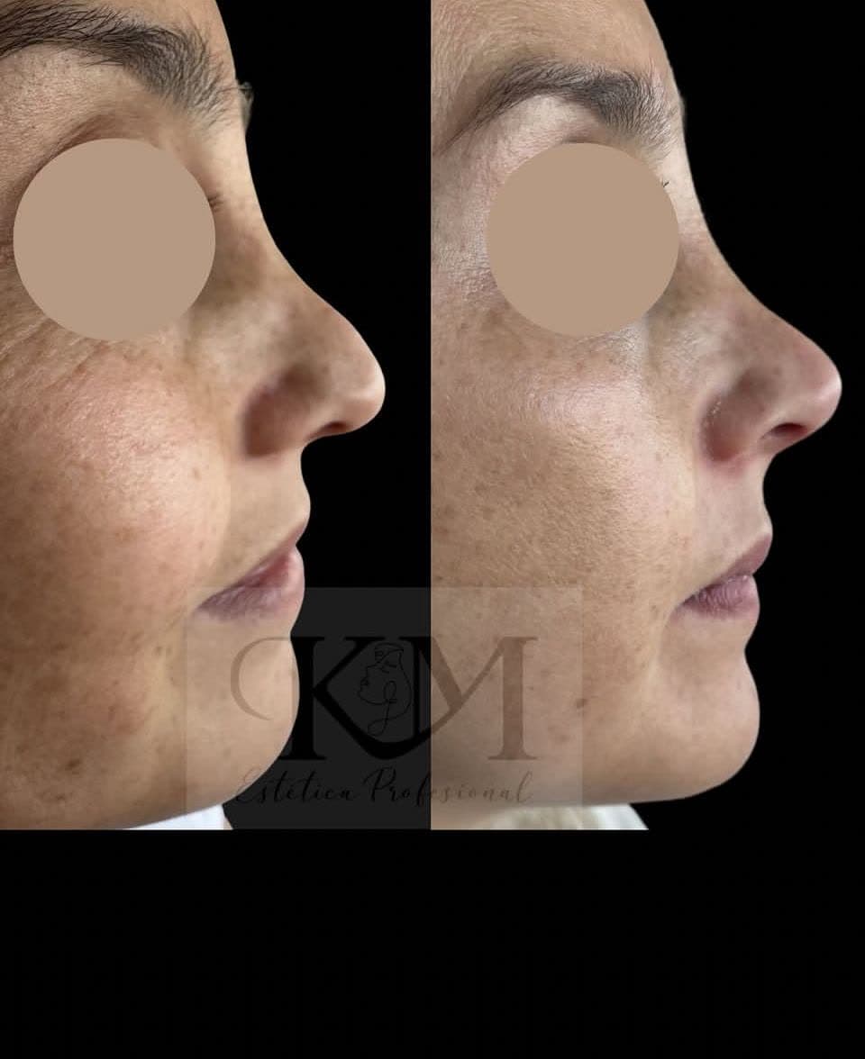 Antes y después — Nariz de perfil: Rinomodelación con ácido hialurónico