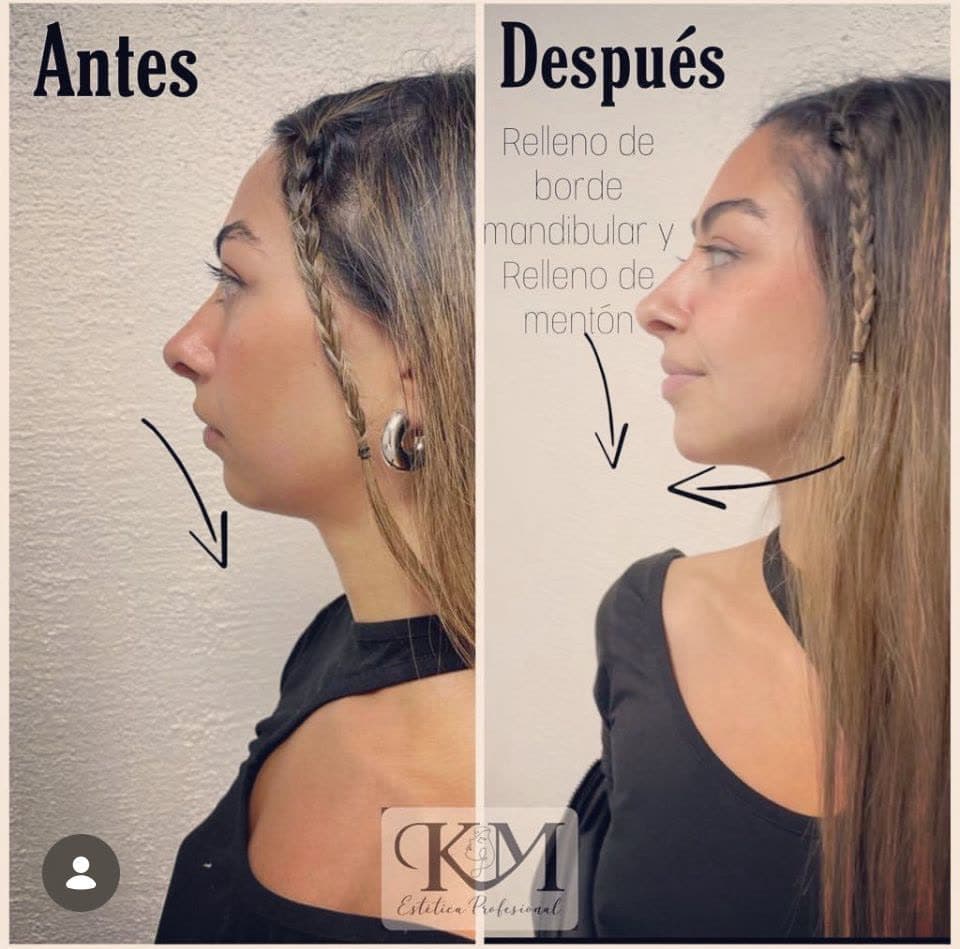 Antes y después — Mandíbula y mentón: Relleno de borde mandibular y mentón